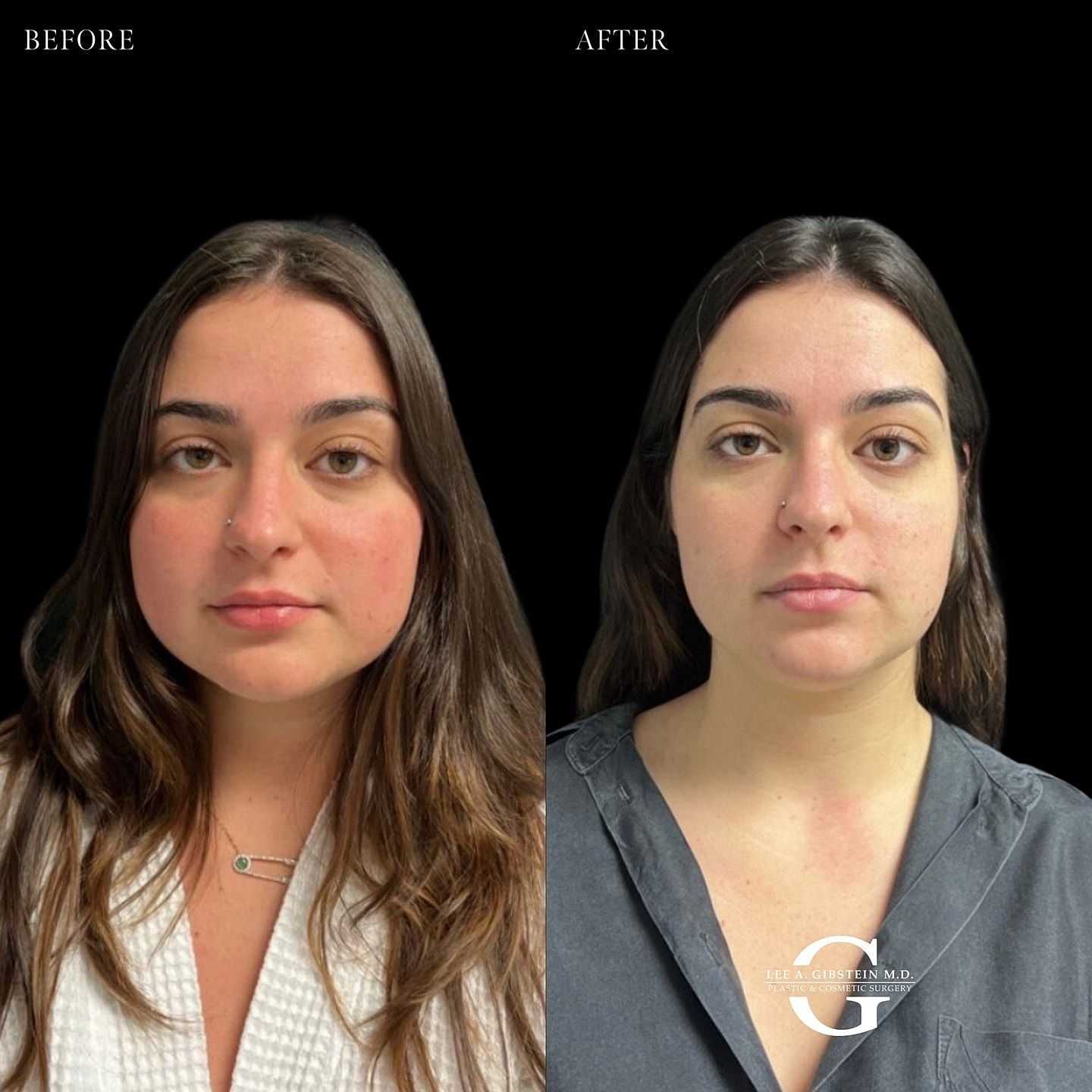Before and after cosmetic treatment comparison.