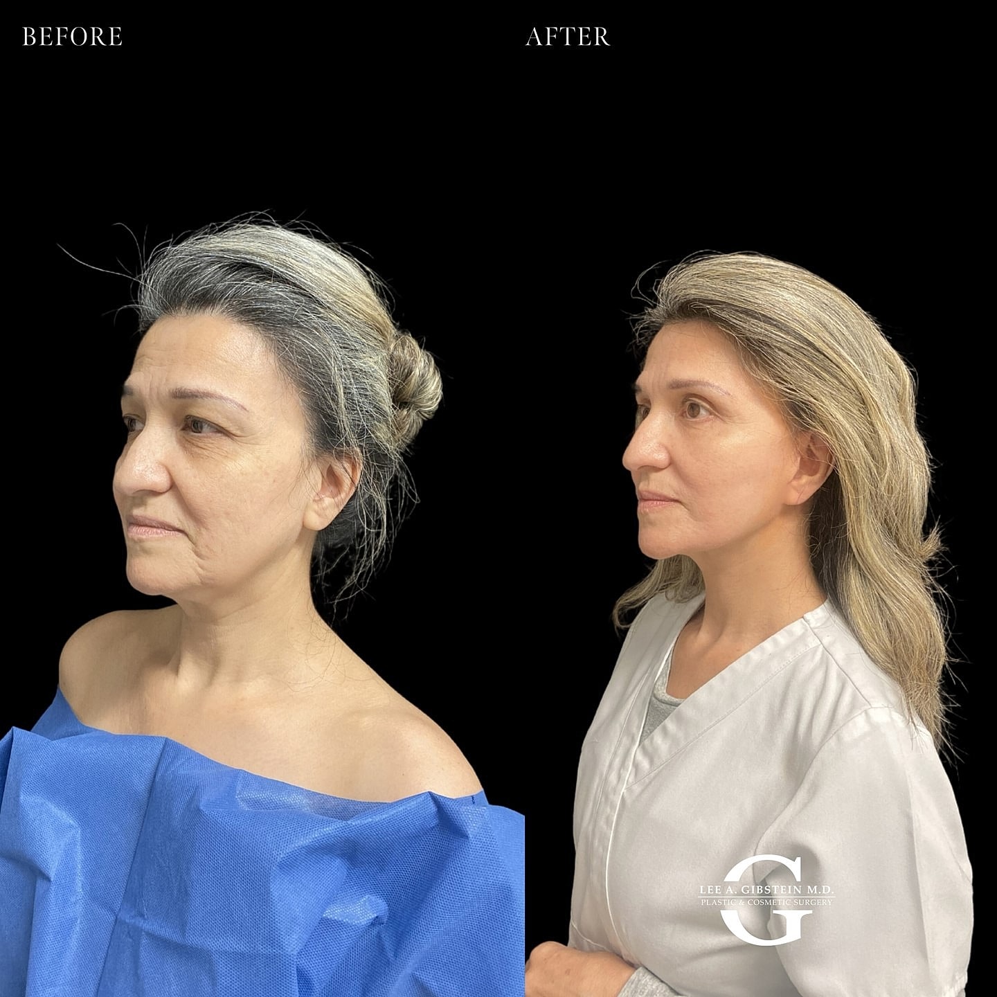 Before and after cosmetic surgery transformation comparison.