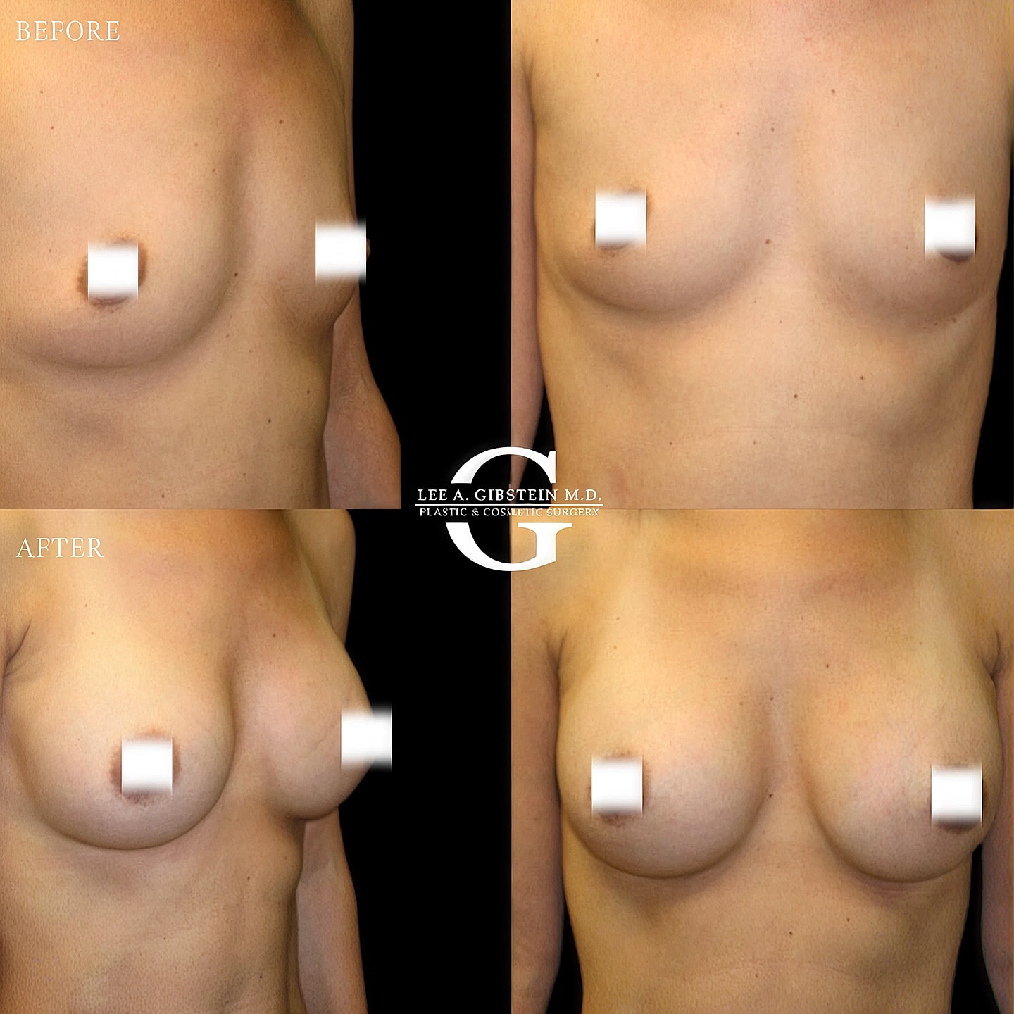 Breast procedure before and after transformation